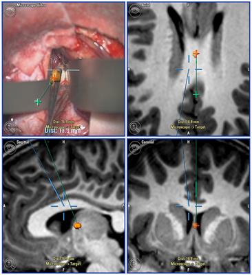 Pediatric Central Nervous System Tumors: State-of-the-Art and Debated Aspects